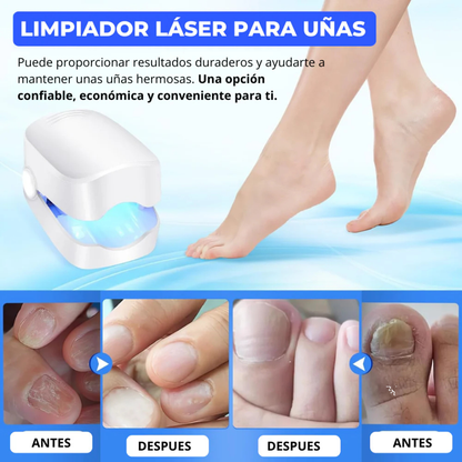 Láser LED para Uñas con Hongos