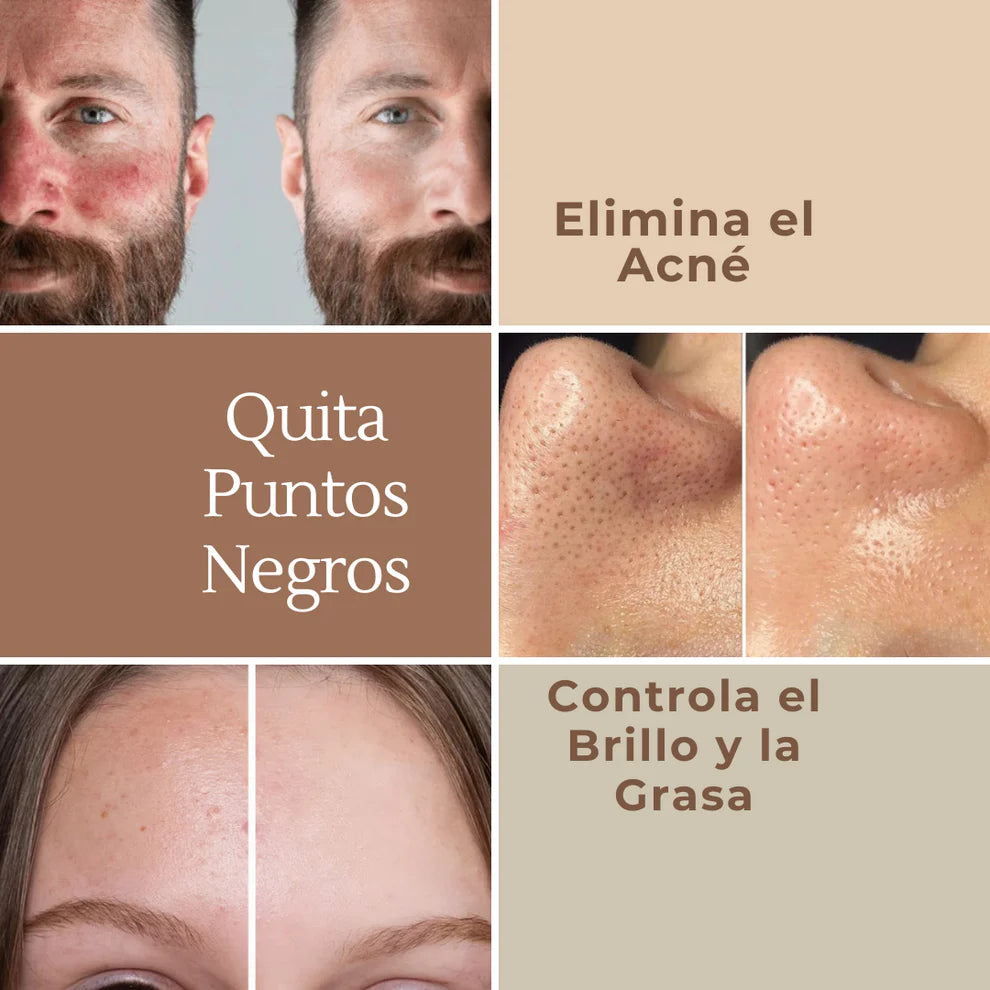 Extractor de Espinillas sin Dolor + Obsequio